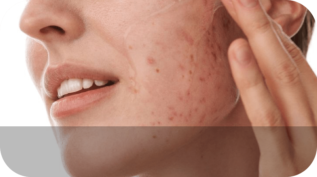 Acne Removal