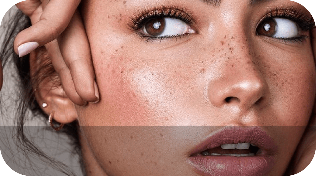 Pigmentation Removal